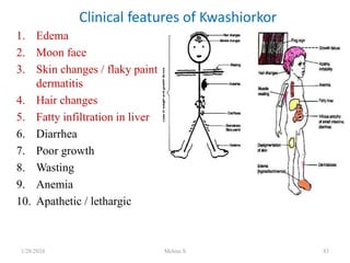 1. Edema
2. Moon face
3. Skin changes / flaky paint
dermatitis
4. Hair changes
5. Fatty infiltration in liver
6. Diarrhea
7. Poor growth
8. Wasting
9. Anemia
10. Apathetic / lethargic
Clinical features of Kwashiorkor
1/28/2024 Melese.S 83
 