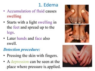 • Accumulation of fluid causes
swelling
• Starts with a light swelling in
the feet and spread up to the
legs.
• Later hands and face also
swell.
Detection procedure:
• Pressing the skin with fingers.
• A depression can be seen at the
place where pressure is applied.
1. Edema
1/28/2024 Melese.S 87
 