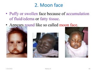 • Puffy or swollen face because of accumulation
of fluid/edema or fatty tissue.
• Appears round like so called moon face.
2. Moon face
1/28/2024 Melese.S 88
 