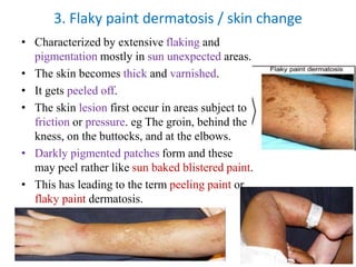 • Characterized by extensive flaking and
pigmentation mostly in sun unexpected areas.
• The skin becomes thick and varnished.
• It gets peeled off.
• The skin lesion first occur in areas subject to
friction or pressure. eg The groin, behind the
kness, on the buttocks, and at the elbows.
• Darkly pigmented patches form and these
may peel rather like sun baked blistered paint.
• This has leading to the term peeling paint or
flaky paint dermatosis.
3. Flaky paint dermatosis / skin change
1/28/2024 Melese.S 89
 