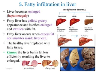• Liver becomes enlarged
(hepatomegaly)
• Fatty liver has yellow greasy
appearance and is often enlarged
and swollen with fat.
• Fatty liver occurs when excess fat
accumulates inside liver cell.
• The healthy liver replaced with
fatty tissue.
• Cause: the liver burns fat less
efficiently resulting the liver to
enlarged.
5. Fatty infiltration in liver
1/28/2024 Melese.S 91
 