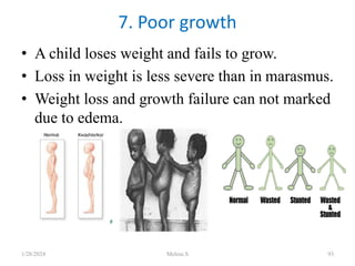 • A child loses weight and fails to grow.
• Loss in weight is less severe than in marasmus.
• Weight loss and growth failure can not marked
due to edema.
7. Poor growth
1/28/2024 Melese.S 93
 