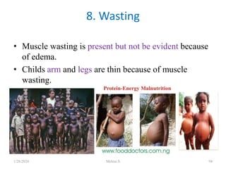 • Muscle wasting is present but not be evident because
of edema.
• Childs arm and legs are thin because of muscle
wasting.
8. Wasting
1/28/2024 Melese.S 94
 