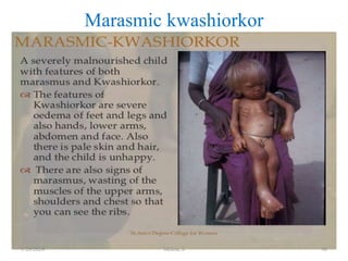 Marasmic kwashiorkor
1/28/2024 Melese.S 96
 