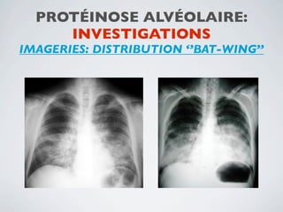 PROTÉINOSE ALVÉOLAIRE:
     INVESTIGATIONS
IMAGERIES: DISTRIBUTION ‘’BAT-WING’’
 
