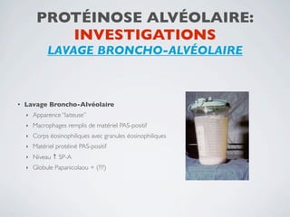 PROTÉINOSE ALVÉOLAIRE:
            INVESTIGATIONS
              LAVAGE BRONCHO-ALVÉOLAIRE



•   Lavage Broncho-Alvéolaire
    ‣   Apparence ‘‘laiteuse’’
    ‣   Macrophages remplis de matériel PAS-positif
    ‣   Corps éosinophiliques avec granules éosinophiliques
    ‣   Matériel protéiné PAS-positif
    ‣   Niveau ↑ SP-A
    ‣   Globule Papanicolaou + (???)
 