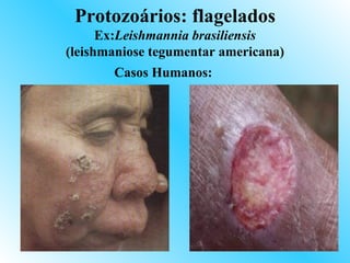 Protozoários: flagelados
      Ex:Leishmannia brasiliensis
(leishmaniose tegumentar americana)
       Casos Humanos:
 