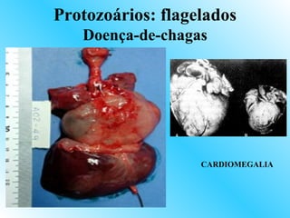 Protozoários: flagelados
   Doença-de-chagas




                   CARDIOMEGALIA
 