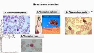 Macam-macam plasmodium 
1.Plasmodium falciparum 
3.Plasmodium malariae 4. Plasmodium ovale 
2.Plasmodium vivax 
 