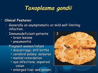 Toxoplasma gondiiToxoplasma gondii
• Clinical FeaturesClinical Features::
•
Generally an asymptomatic or mild self-limitingGenerally an asymptomatic or mild self-limiting
infection. infection. 
•
Immunodeficient patientsImmunodeficient patients
• brain lesionsbrain lesions
• pneumonitispneumonitis
•
Pregnant women/infantPregnant women/infant
• miscarriage; still birthsmiscarriage; still births
• cerebral palsey; seisurescerebral palsey; seisures
• mental retardationmental retardation
• eye infections; impairedeye infections; impaired
visionvision
• enlarged liver and spleenenlarged liver and spleen
 