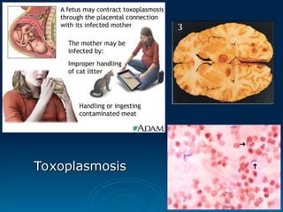 Toxoplasmosis
Toxoplasmosis
 