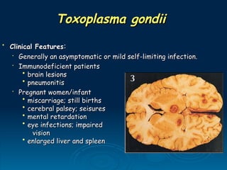 Toxoplasma gondii
Toxoplasma gondii
• Clinical Features
Clinical Features:
:
•
Generally an asymptomatic or mild self-limiting infection.
Generally an asymptomatic or mild self-limiting infection.
•
Immunodeficient patients
Immunodeficient patients
• brain lesions
brain lesions
• pneumonitis
pneumonitis
•
Pregnant women/infant
Pregnant women/infant
• miscarriage; still births
miscarriage; still births
• cerebral palsey; seisures
cerebral palsey; seisures
• mental retardation
mental retardation
• eye infections; impaired
eye infections; impaired
vision
vision
• enlarged liver and spleen
enlarged liver and spleen
 