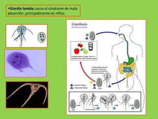 Giardia lambia  causa el s í ndrome de mala absorci ó n ,principalmente en ni ñ os. 