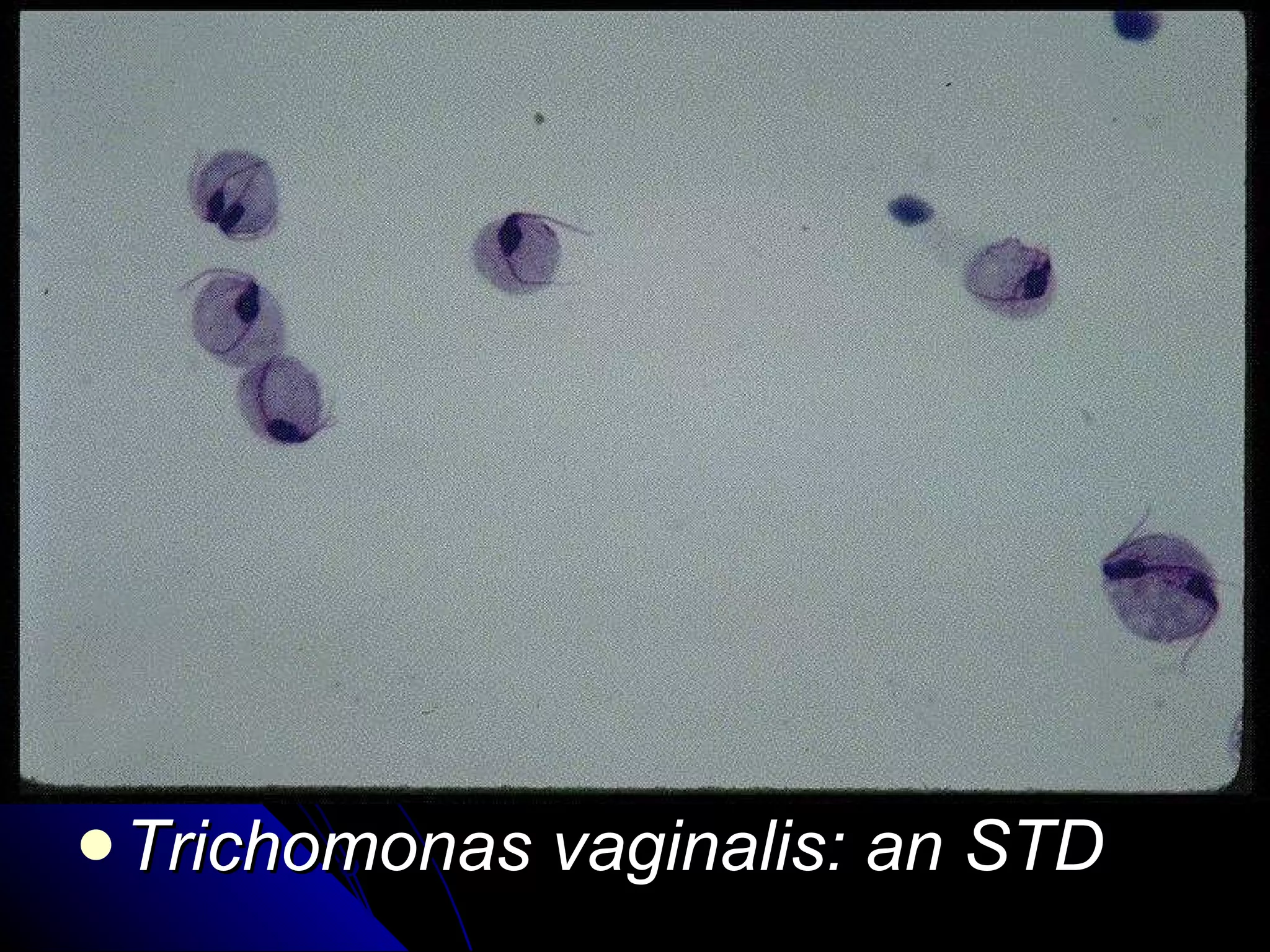 Trichomonas vaginalis: an STD 