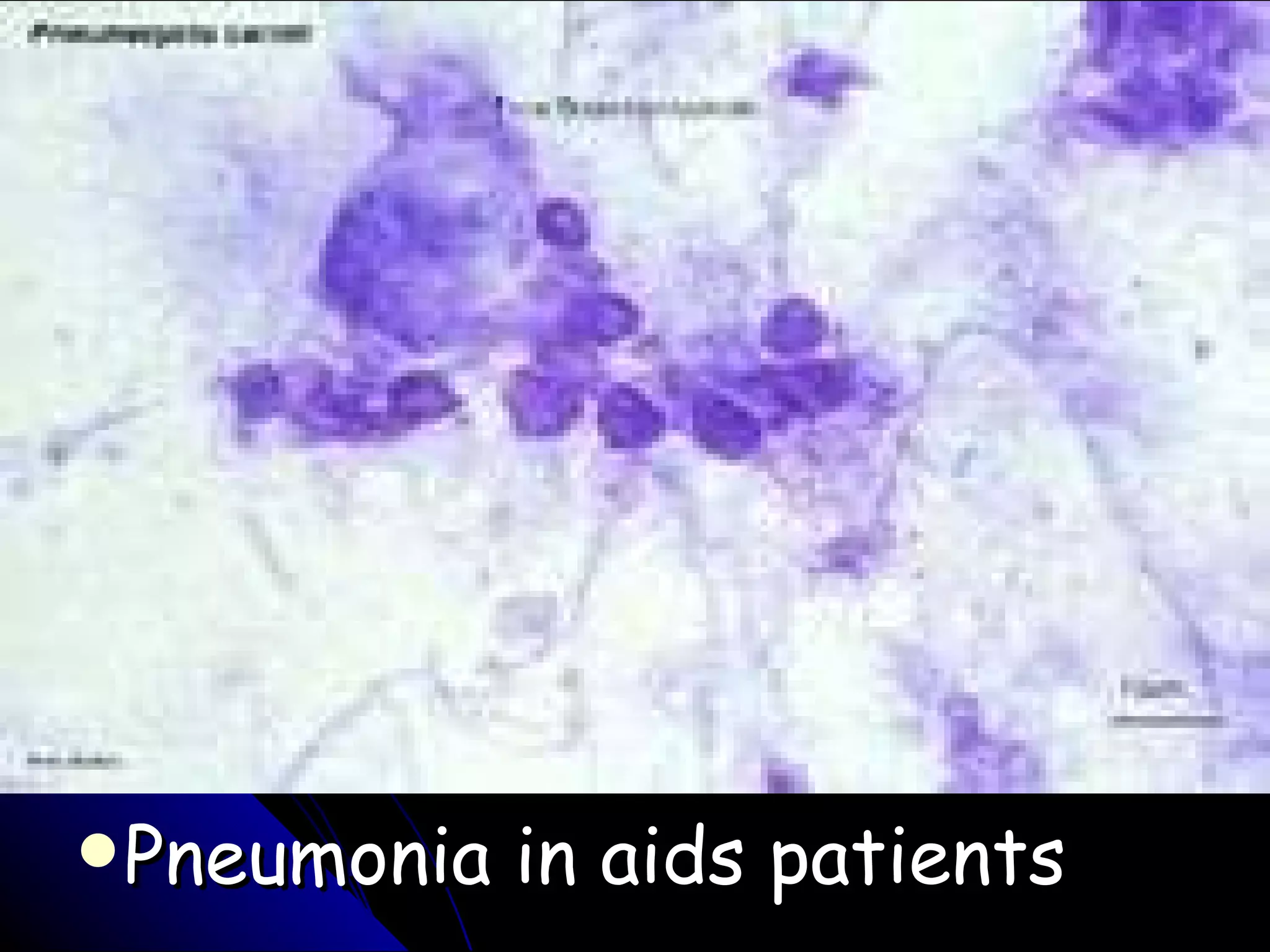 Pneumonia in aids patients 