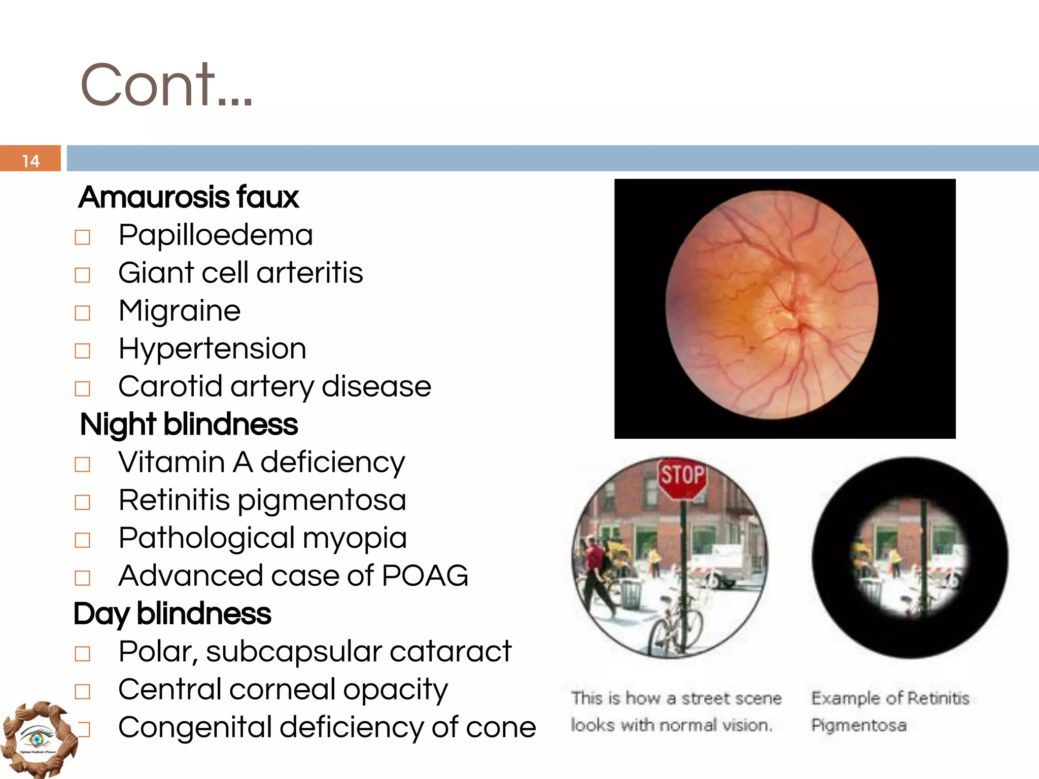 Cont...
Amaurosis faux
◻ Papilloedema
◻ Giant cell arteritis
◻ Migraine
◻ Hypertension
◻ Carotid artery disease
Night blindness
◻ Vitamin A deficiency
◻ Retinitis pigmentosa
◻ Pathological myopia
◻ Advanced case of POAG
Day blindness
◻ Polar, subcapsular cataract
◻ Central corneal opacity
◻ Congenital deficiency of cone
14
 