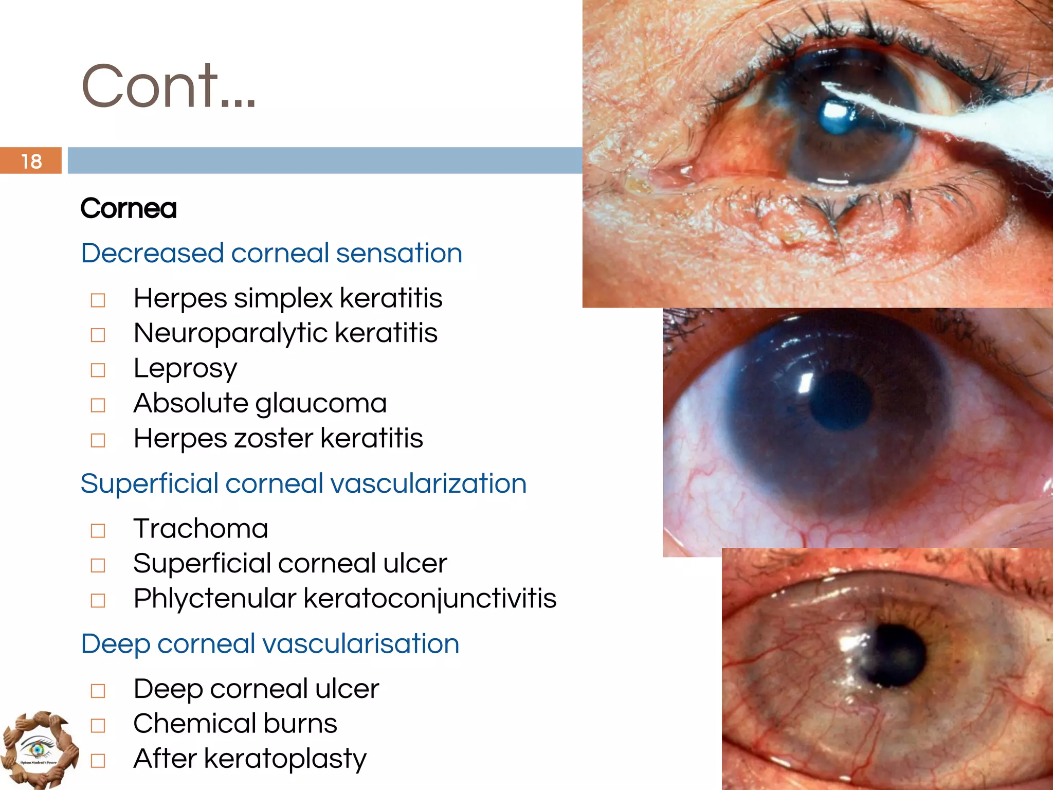 Cont...
Cornea
Decreased corneal sensation
◻ Herpes simplex keratitis
◻ Neuroparalytic keratitis
◻ Leprosy
◻ Absolute glaucoma
◻ Herpes zoster keratitis
Superficial corneal vascularization
◻ Trachoma
◻ Superficial corneal ulcer
◻ Phlyctenular keratoconjunctivitis
Deep corneal vascularisation
◻ Deep corneal ulcer
◻ Chemical burns
◻ After keratoplasty
18
 