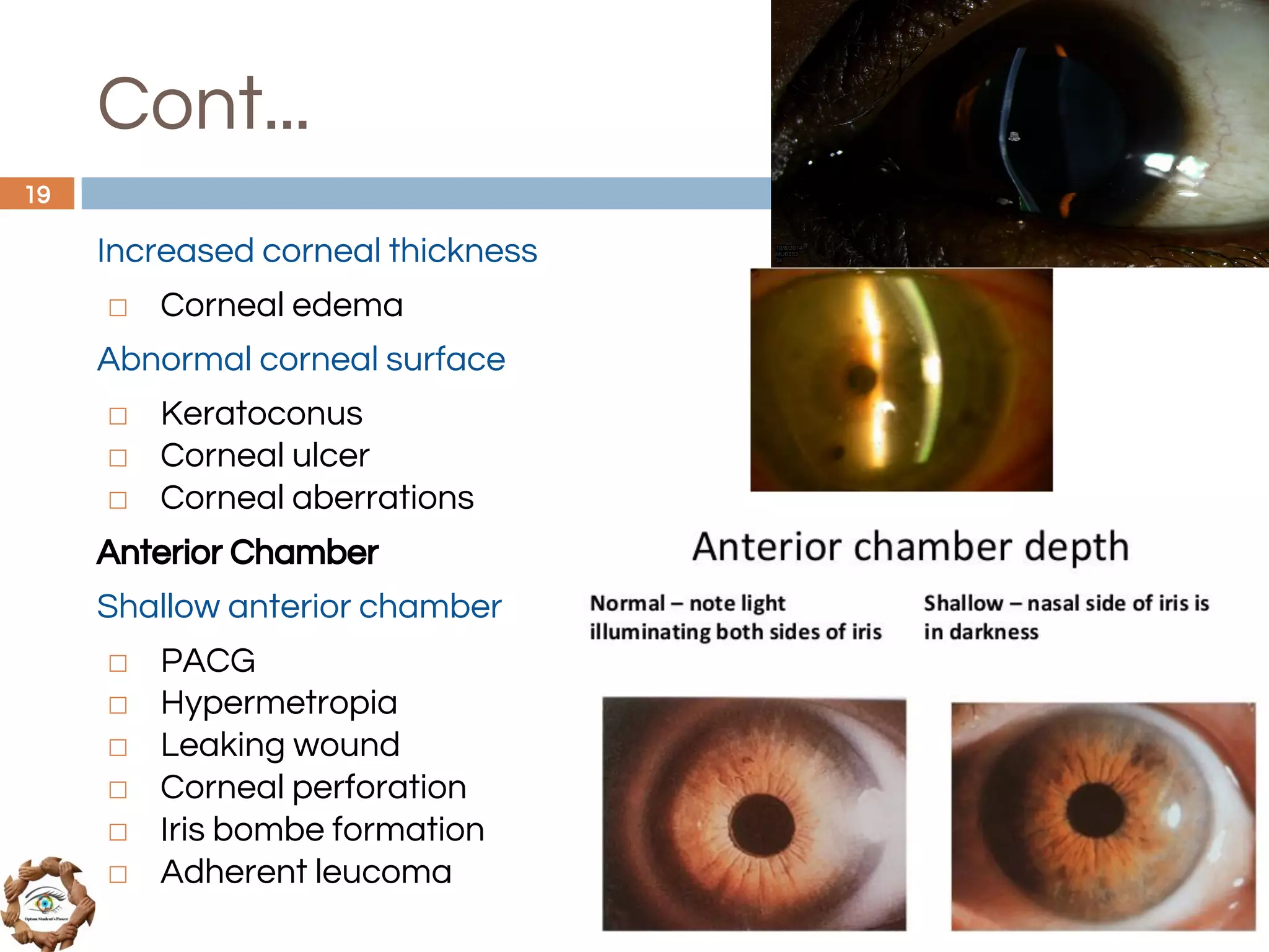 Cont...
Increased corneal thickness
◻ Corneal edema
Abnormal corneal surface
◻ Keratoconus
◻ Corneal ulcer
◻ Corneal aberrations
Anterior Chamber
Shallow anterior chamber
◻ PACG
◻ Hypermetropia
◻ Leaking wound
◻ Corneal perforation
◻ Iris bombe formation
◻ Adherent leucoma
19
 