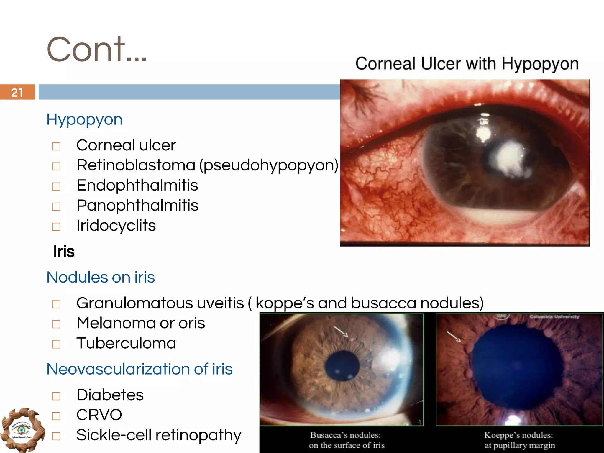 Cont...
Hypopyon
◻ Corneal ulcer
◻ Retinoblastoma (pseudohypopyon)
◻ Endophthalmitis
◻ Panophthalmitis
◻ Iridocyclits
Iris
Nodules on iris
◻ Granulomatous uveitis ( koppe’s and busacca nodules)
◻ Melanoma or oris
◻ Tuberculoma
Neovascularization of iris
◻ Diabetes
◻ CRVO
◻ Sickle-cell retinopathy
21
 