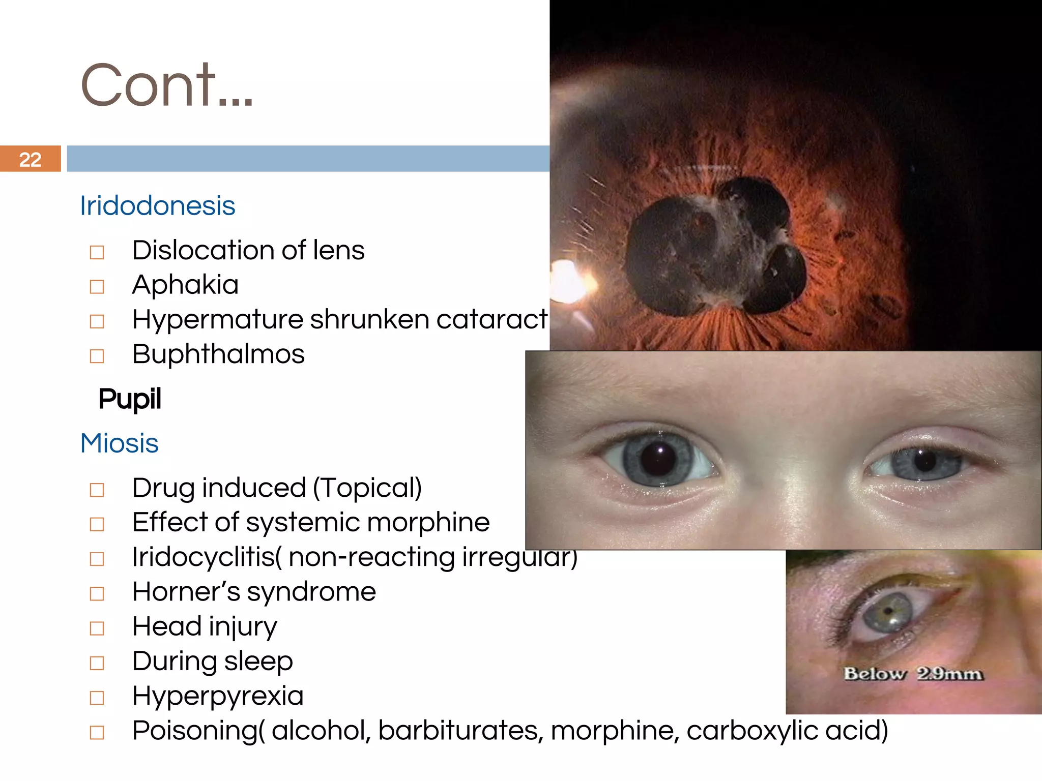 Cont...
Iridodonesis
◻ Dislocation of lens
◻ Aphakia
◻ Hypermature shrunken cataract
◻ Buphthalmos
Pupil
Miosis
◻ Drug induced (Topical)
◻ Effect of systemic morphine
◻ Iridocyclitis( non-reacting irregular)
◻ Horner’s syndrome
◻ Head injury
◻ During sleep
◻ Hyperpyrexia
◻ Poisoning( alcohol, barbiturates, morphine, carboxylic acid)
22
 