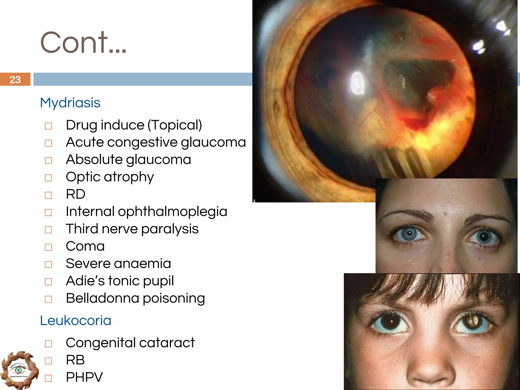 Cont...
Mydriasis
◻ Drug induce (Topical)
◻ Acute congestive glaucoma
◻ Absolute glaucoma
◻ Optic atrophy
◻ RD
◻ Internal ophthalmoplegia
◻ Third nerve paralysis
◻ Coma
◻ Severe anaemia
◻ Adie’s tonic pupil
◻ Belladonna poisoning
Leukocoria
◻ Congenital cataract
◻ RB
◻ PHPV
23
 