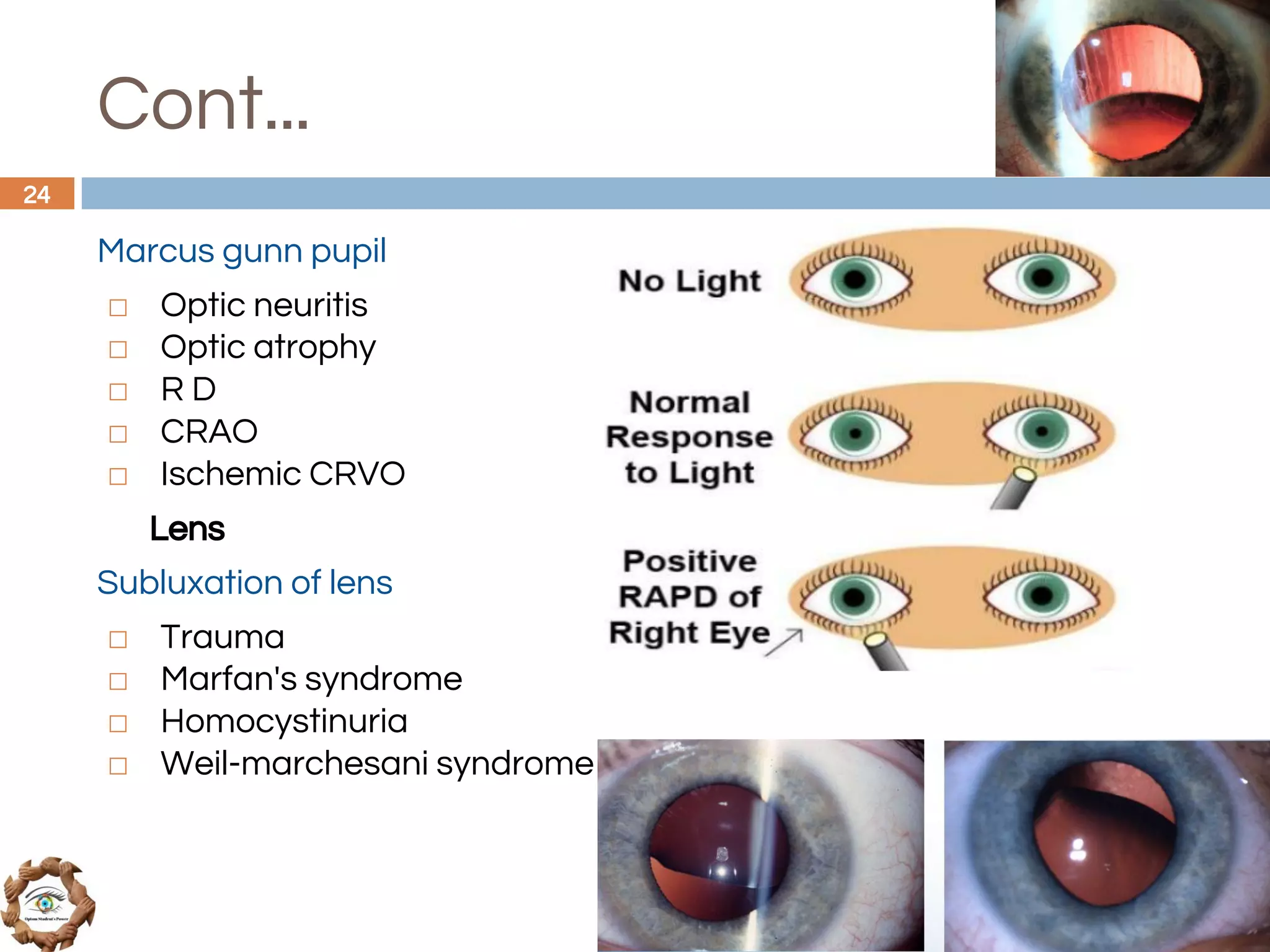 Cont...
Marcus gunn pupil
◻ Optic neuritis
◻ Optic atrophy
◻ R D
◻ CRAO
◻ Ischemic CRVO
Lens
Subluxation of lens
◻ Trauma
◻ Marfan's syndrome
◻ Homocystinuria
◻ Weil-marchesani syndrome
24
 