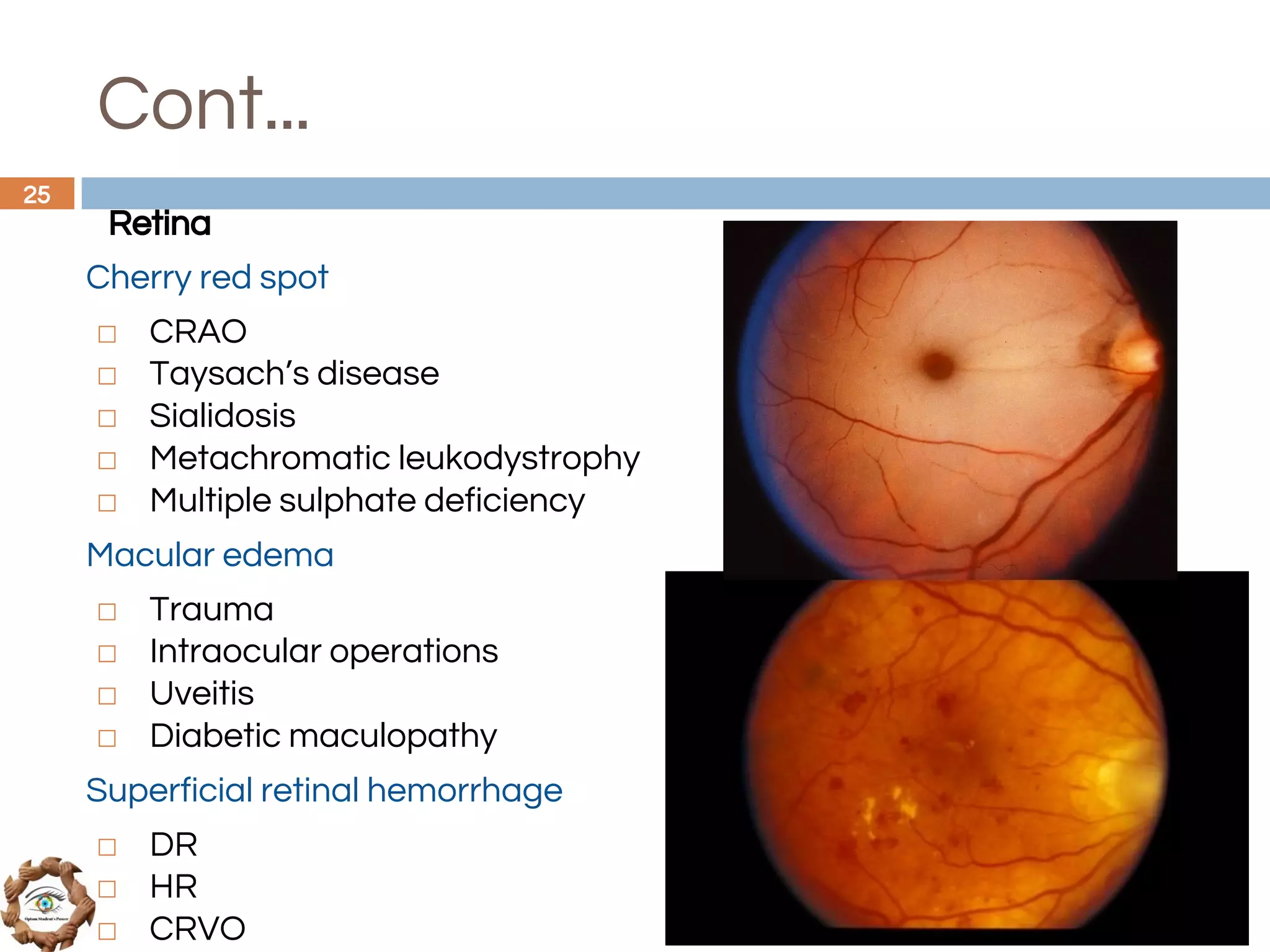 Cont...
Retina
Cherry red spot
◻ CRAO
◻ Taysach’s disease
◻ Sialidosis
◻ Metachromatic leukodystrophy
◻ Multiple sulphate deficiency
Macular edema
◻ Trauma
◻ Intraocular operations
◻ Uveitis
◻ Diabetic maculopathy
Superficial retinal hemorrhage
◻ DR
◻ HR
◻ CRVO
25
 