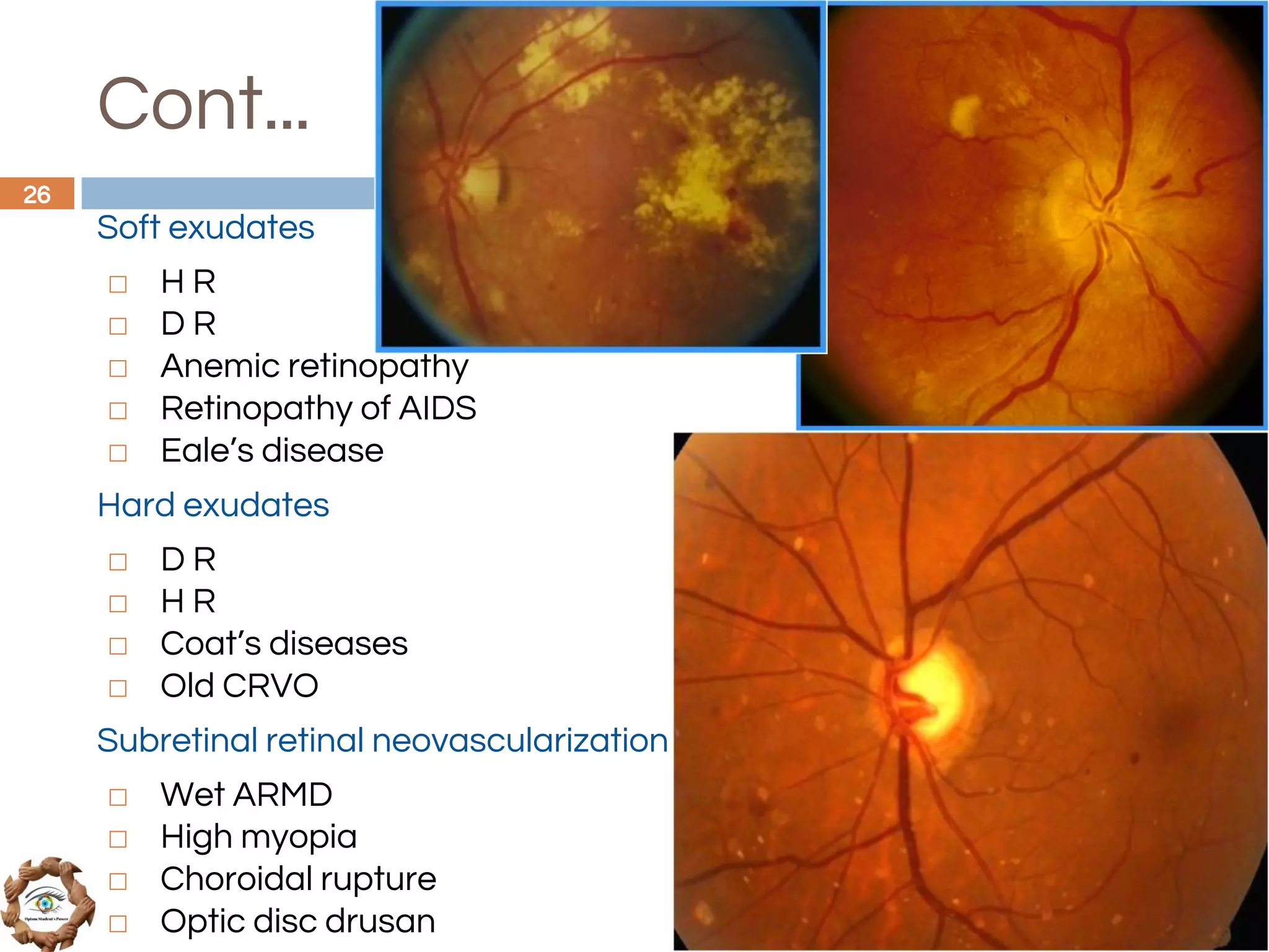 Cont...
Soft exudates
◻ H R
◻ D R
◻ Anemic retinopathy
◻ Retinopathy of AIDS
◻ Eale’s disease
Hard exudates
◻ D R
◻ H R
◻ Coat’s diseases
◻ Old CRVO
Subretinal retinal neovascularization
◻ Wet ARMD
◻ High myopia
◻ Choroidal rupture
◻ Optic disc drusan
26
 