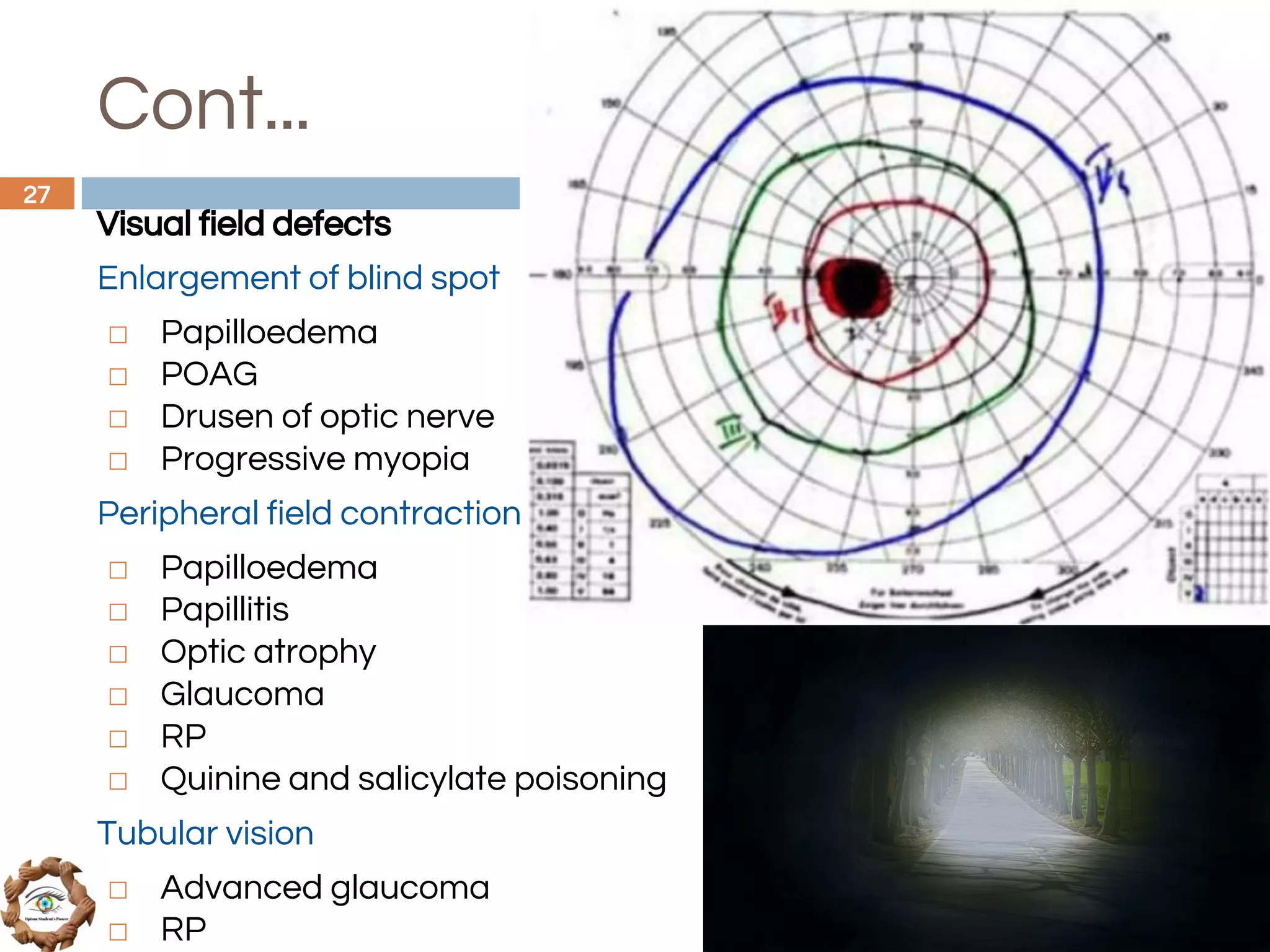 Cont...
Visual field defects
Enlargement of blind spot
◻ Papilloedema
◻ POAG
◻ Drusen of optic nerve
◻ Progressive myopia
Peripheral field contraction
◻ Papilloedema
◻ Papillitis
◻ Optic atrophy
◻ Glaucoma
◻ RP
◻ Quinine and salicylate poisoning
Tubular vision
◻ Advanced glaucoma
◻ RP
27
 
