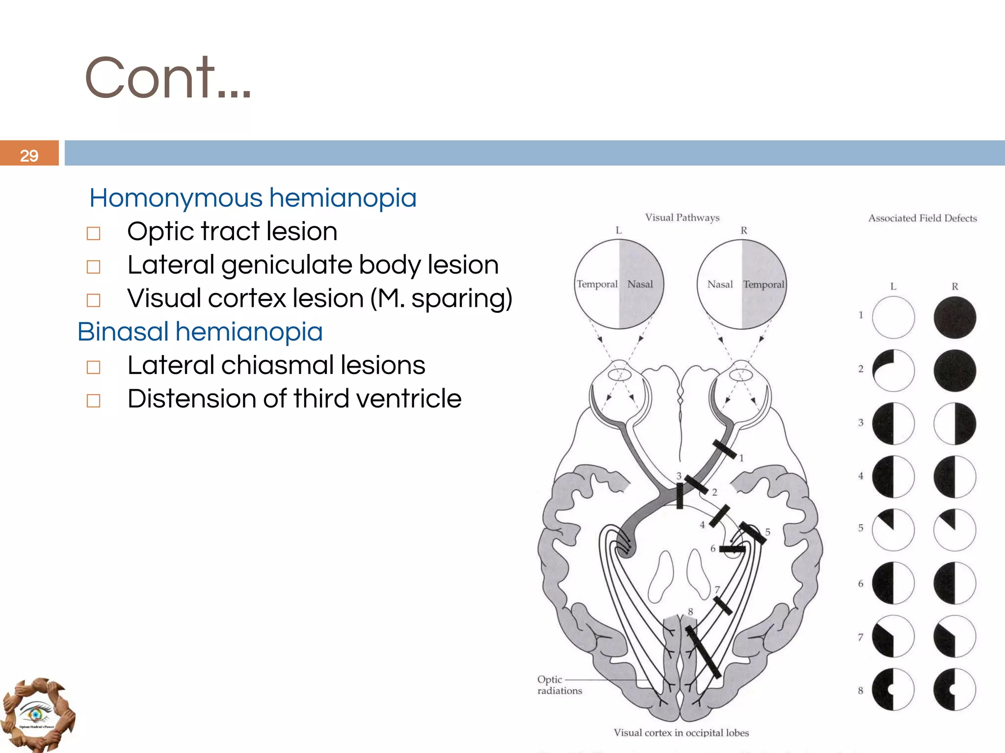 Homonymous hemianopia
◻ Optic tract lesion
◻ Lateral geniculate body lesion
◻ Visual cortex lesion (M. sparing)
Binasal hemianopia
◻ Lateral chiasmal lesions
◻ Distension of third ventricle
29
Cont...
 