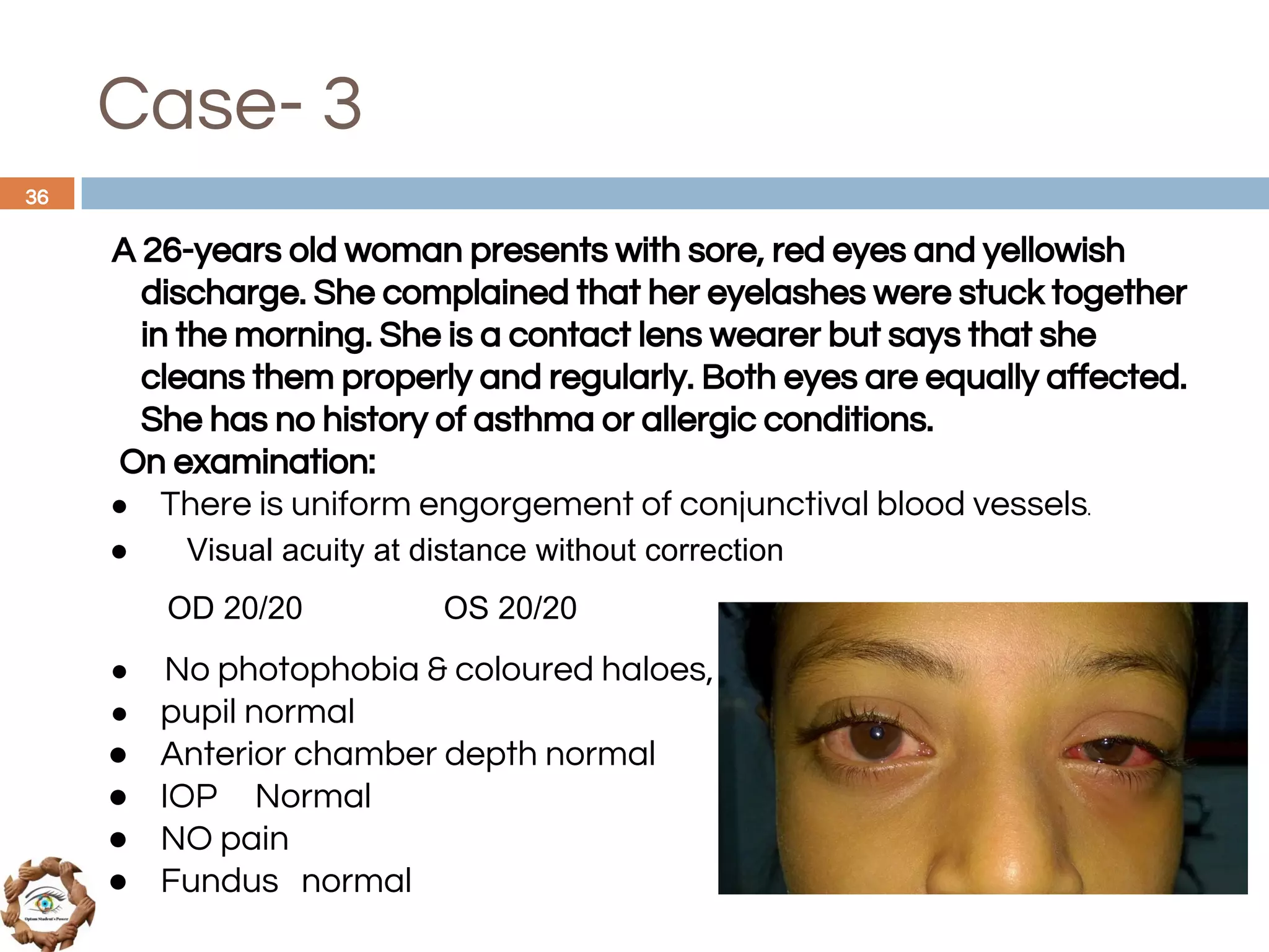 Case- 3
A 26-years old woman presents with sore, red eyes and yellowish
discharge. She complained that her eyelashes were stuck together
in the morning. She is a contact lens wearer but says that she
cleans them properly and regularly. Both eyes are equally affected.
She has no history of asthma or allergic conditions.
On examination:
● There is uniform engorgement of conjunctival blood vessels.
● Visual acuity at distance without correction
OD 20/20 OS 20/20
● No photophobia & coloured haloes,
● pupil normal
● Anterior chamber depth normal
● IOP Normal
● NO pain
● Fundus normal
36
 