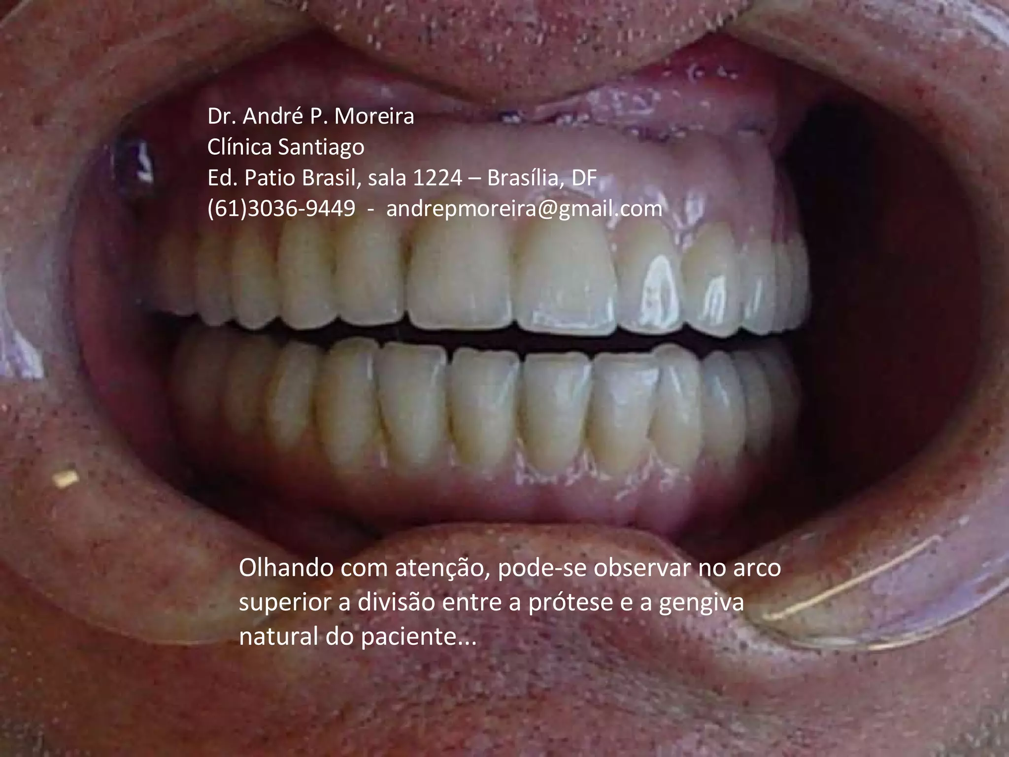 Protocolo De Branemark | PPT | Oral care | Personal Care