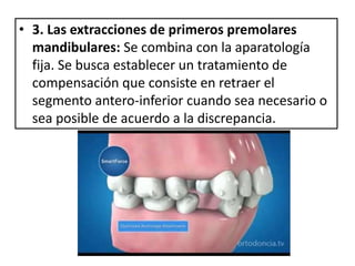 • 3. Las extracciones de primeros premolares
mandibulares: Se combina con la aparatología
fija. Se busca establecer un tratamiento de
compensación que consiste en retraer el
segmento antero-inferior cuando sea necesario o
sea posible de acuerdo a la discrepancia.
 