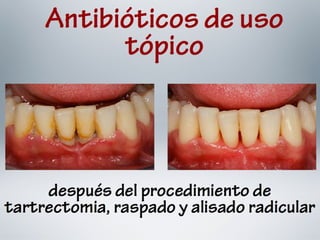 Protocolo en el Uso de Antibióticos en Odontología