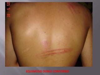 EQUIMOSIS DOBLE CONTORNO 
 