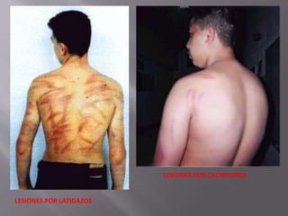 LESIONES POR LATIGAZOS 
LESIONES POR CACHIPORRA 
 
