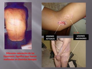 Diferente coloración de las 
Equimosis: Significa que fueron 
realizadas en Distintos tiempos. 
LESIONES 
ANTERIORES 
LESIONES 
ACTUALES 
 