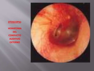 OTOSCOPIA: 
HEMATOMA 
DEL 
CONDUCTO 
AUDITIVO 
EXTERNO 
 