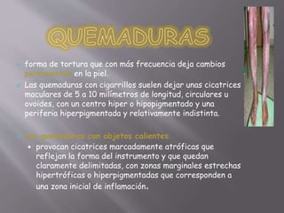  forma de tortura que con más frecuencia deja cambios 
permanentes en la piel. 
 Las quemaduras con cigarrillos suelen dejar unas cicatrices 
maculares de 5 a 10 milímetros de longitud, circulares u 
ovoides, con un centro hiper o hipopigmentado y una 
periferia hiperpigmentada y relativamente indistinta. 
 Las quemaduras con objetos calientes 
 provocan cicatrices marcadamente atróficas que 
reflejan la forma del instrumento y que quedan 
claramente delimitadas, con zonas marginales estrechas 
hipertróficas o hiperpigmentadas que corresponden a 
una zona inicial de inflamación. 
 