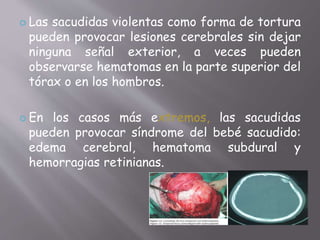  Las sacudidas violentas como forma de tortura 
pueden provocar lesiones cerebrales sin dejar 
ninguna señal exterior, a veces pueden 
observarse hematomas en la parte superior del 
tórax o en los hombros. 
 En los casos más extremos, las sacudidas 
pueden provocar síndrome del bebé sacudido: 
edema cerebral, hematoma subdural y 
hemorragias retinianas. 
 