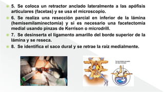  5. Se coloca un retractor anclado lateralmente a las apófisis
articulares (facetas) y se usa el microscopio.
 6. Se realiza una resección parcial en inferior de la lámina
(hemisemilaminectomía) y si es necesario una facetectomía
medial usando pinzas de Kerrison o microdrill.
 7. Se desinserta el ligamento amarillo del borde superior de la
lámina y se reseca.
 8. Se identifica el saco dural y se retrae la raíz medialmente.
 