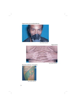 74
Hipercromia, leucomelanodermia.
Hipocromia
Manchas artificiais. Tatuagens.
Foto: Salim Amed Ali
Foto: Salim Amed Ali
Foto: Salim Amed Ali
 