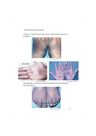 75
-Alterações na espessura da pele:
Ceratose = hiperceratose. Aumento de camada córnea: hipercerato-
se folicular.
Liquenificação - aumento na espessura da epiderme com acentuação
dos sulcos e da cor.
calosidade
calosidade
Áreas de hipercromia e
liquenificação
Foto: Salim Amed Ali
Foto: Salim Amed Ali Foto: Salim Amed Ali
Foto: Salim Amed Ali
 