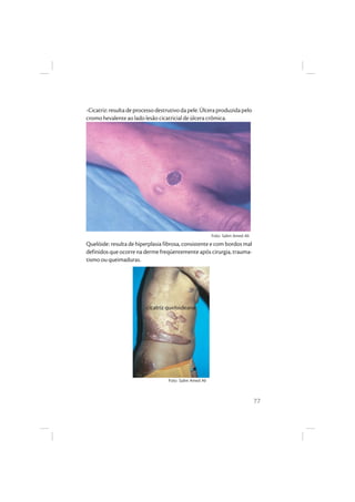 77
-Cicatriz:resultadeprocessodestrutivodapele.Úlceraproduzidapelo
cromo hevalente ao lado lesão cicatricial de úlcera crômica.
Quelóide: resulta de hiperplasia fibrosa, consistente e com bordos mal
definidos que ocorre na derme freqüentemente após cirurgia, trauma-
tismo ou queimaduras.
cicatriz queloideana
Foto: Salim Amed Ali
Foto: Salim Amed Ali
 