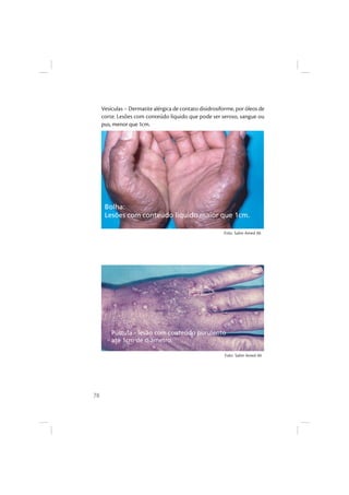 78
Vesículas – Dermatite alérgica de contato disidrosiforme, por óleos de
corte. Lesões com conteúdo líquido que pode ser seroso, sangue ou
pus, menor que 1cm.
Bolha:
Lesões com conteúdo liquido maior que 1cm.
Pústula - lesão com conteúdo purulento
até 1cm de diâmetro.
Foto: Salim Amed Ali
Foto: Salim Amed Ali
 