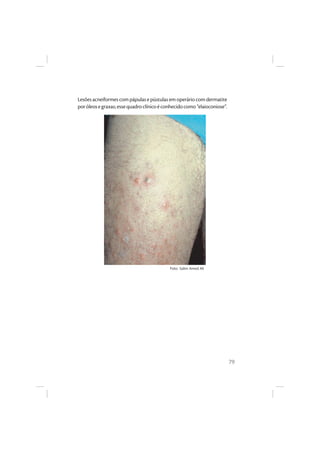 79
Lesões acneiformes com pápulas e pústulas em operário com dermatite
poróleosegraxas;essequadroclínicoéconhecidocomo“elaioconiose”.
Foto: Salim Amed Ali
 