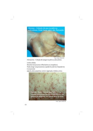 80
Hematoma – Coleção de sangue na pele ou subcutâneo.
Lesões sólidas.
Resultam de processo inflamatório ou neoplásico.
Pode atingir conjuntamente a epiderme, derme e hipoderme.
Compreende:
pápula, placa papulosa, tumor, vegetação, nódulo, urtica.
Pápula - lesão menor que 1cm.
Lesões papulosas devido a obstrução da
glândula sebácea por óleos e/ou graxas.
Abcesso – Coleção de pus na pele ou
subcutâneo. Pode haver calor, dor, flutuação.
Foto: Salim Amed Ali
Foto: Salim Amed Ali
 