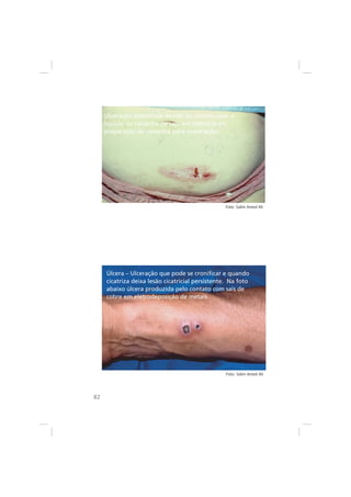 82
Ulceração abdominal devido ao contato com o
líquido da castanha de caju em indústria de
preparação de castanha para exportação.
Úlcera – Ulceração que pode se cronificar e quando
cicatriza deixa lesão cicatricial persistente. Na foto
abaixo úlcera produzida pelo contato com sais de
cobre em eletrodeposição de metais.
Foto: Salim Amed Ali
Foto: Salim Amed Ali
 
