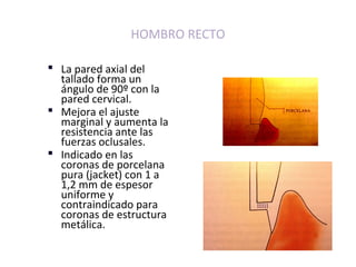Protocolo de Tallado.pdf