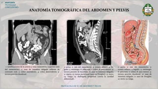 PROTOCOLO DE TC DE ABDOMEN Y PELVIS
 ANATOMÍA
PROTOCOLO
CONCLUSIONES
ANATOMÍA TOMOGRÁFICA DEL ABDOMEN Y PELVIS
1: ramificaciones de la arteria y vena mesentérica superior (raíz
del mesenterio); 2: asas de intestino delgado rellenas de
contraste oral; 3: colon ascendente; 4: colon descendente; 5:
tercera porción duodenal.
1: aorta; 2: raíz del mesenterio; 3: tronco celiaco; 4: hí-
gado; 5: estómago; 6: páncreas; 7: colon; 8: saco menor; 9:
tercera porción de duodeno; 10: asas de intestino delgado;
11: sigma; 12: receso peritoneal (saco de Douglas); 13: recto;
14: vejiga; 15: diafragma urogenital (cierra la cavidad
abdominal).
1: aorta; 2: raíz del mesenterio; 3:
tronco celiaco; 4 hígado; 5: estómago;
6: páncreas; 7: colon; 8: saco menor; 9:
tercera porción duodenal; 10: asas de
intestino delgado; 11: saco de Douglas;
12: recto; 13: vejiga.
 